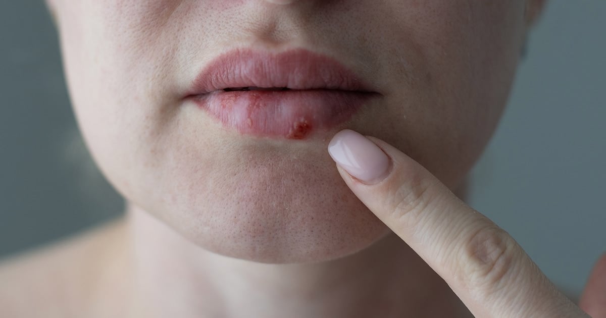 Pritelivir: la pastilla que reabre la pelea contra el herpes cuando todo lo demás ya falló