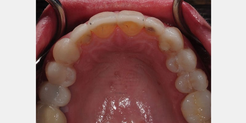Carillas dentales: señales tempranas de una filtración y cómo evitar que avance