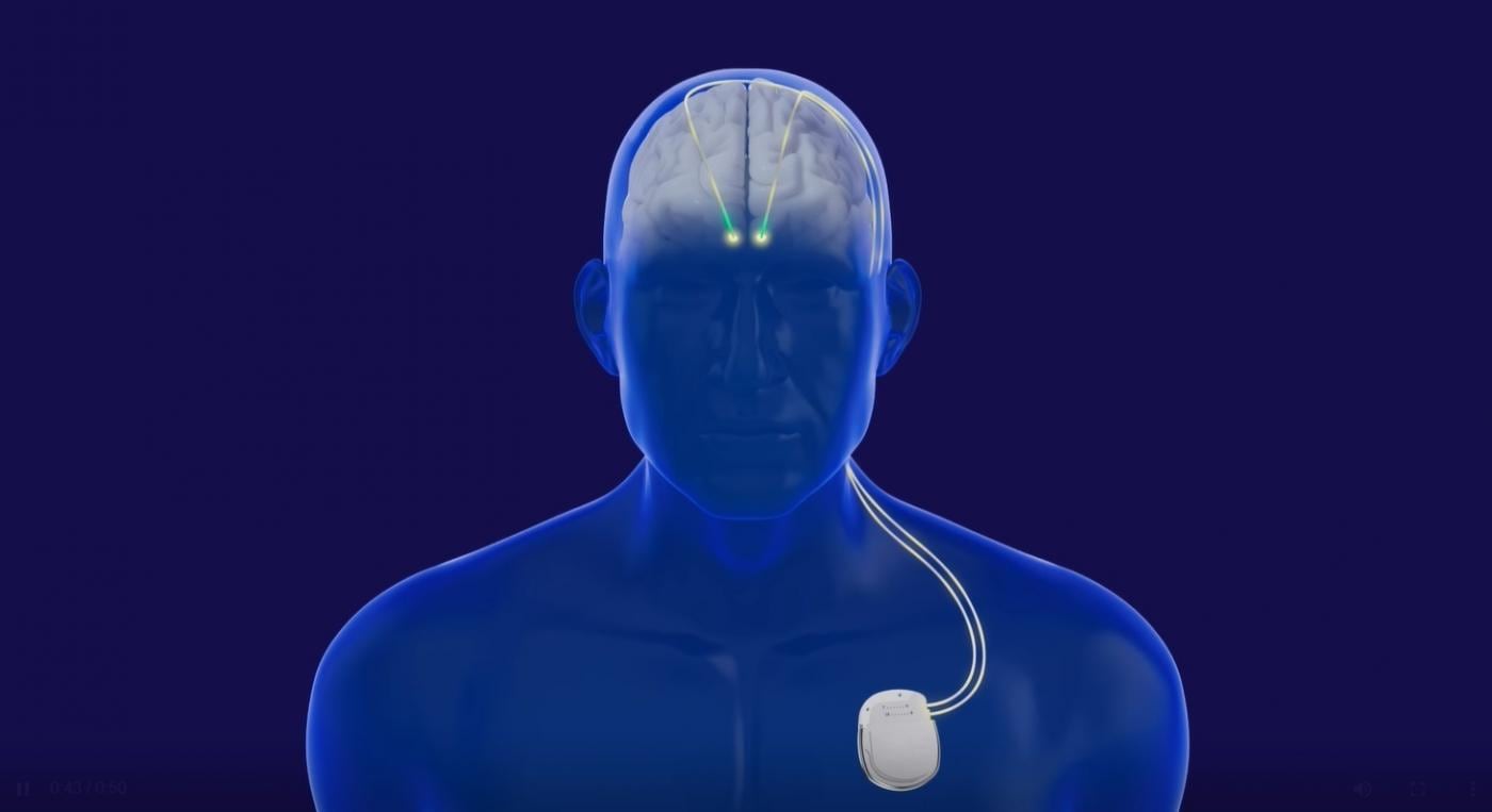 Parkinson: cómo funciona el implante con IA que disminuye la rigidez y los temblores